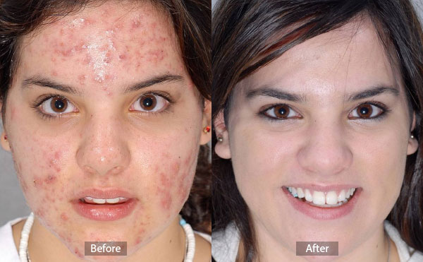 Acne Before and After