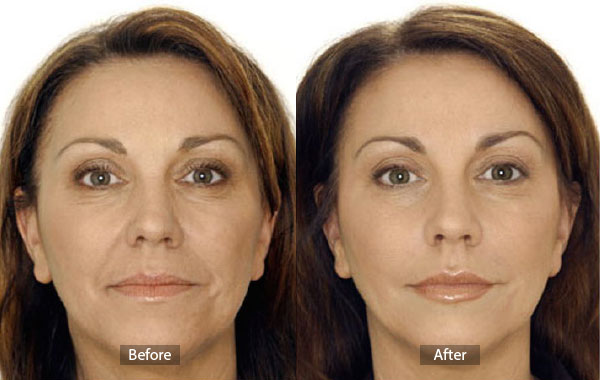 Botox Before and After