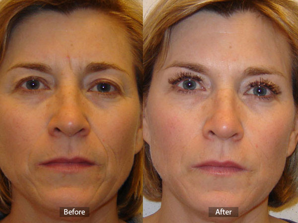 Juvederm Before and After