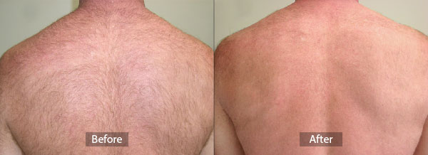 Laser Hair Removal Before and After