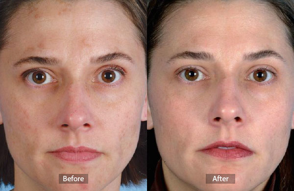 Microdermabrasion Before and After